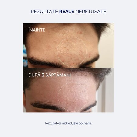 Ser cu acid salicilic 2%, pentru tenul sensibil si acneic, 30 ml, Meloni 643474