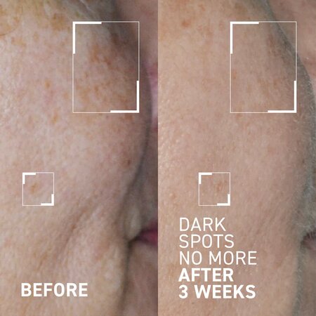Concentrat triplu cu acizi pentru minimizarea petelor pigmentare Dark Spots No More Bright This Way, 15 ml, Dr. Brandt 647649