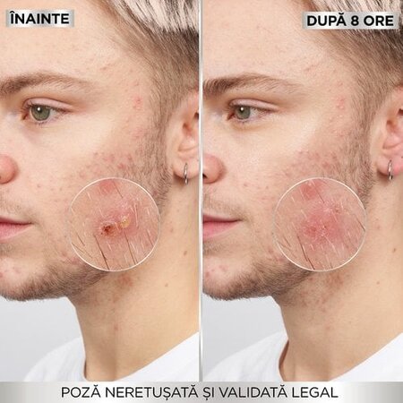 Plasturi invizibili pentru cosuri Pure Active, 22 bucati, Garnier 691995
