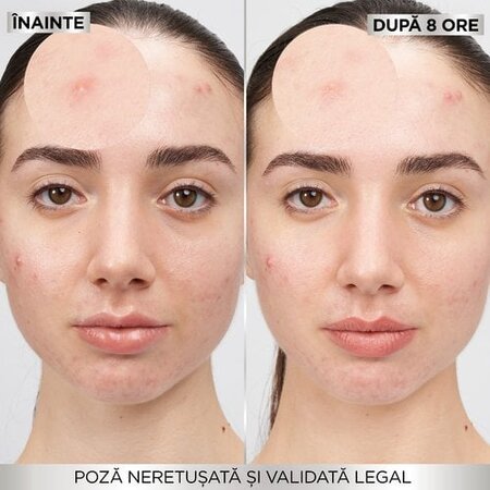 Plasturi invizibili pentru cosuri Pure Active, 22 bucati, Garnier 691992