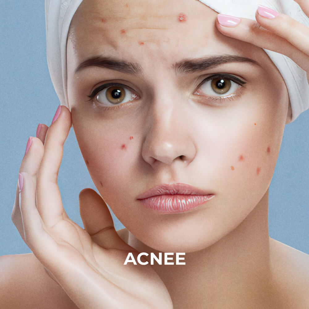 Sesderma &mdash; Acnee