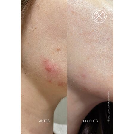 Serum pentru semne post-acneice cu AHA si BHA Postzit Acnemy, 30 ml, Niche Beauty 688648